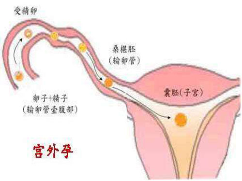 宫外孕是怎么回事宫外孕症状