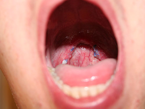 喉咙里有红色疙瘩图片图片
